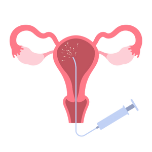 The IUI Procedure